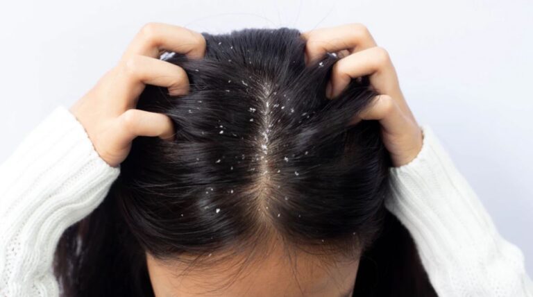 How to Remove the Dandruff Permanently