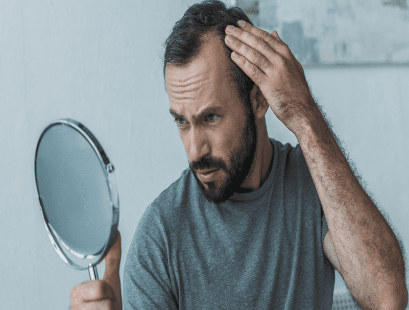 Male's Pattern Baldness Treatment | How to Get Rid From Hair Loss