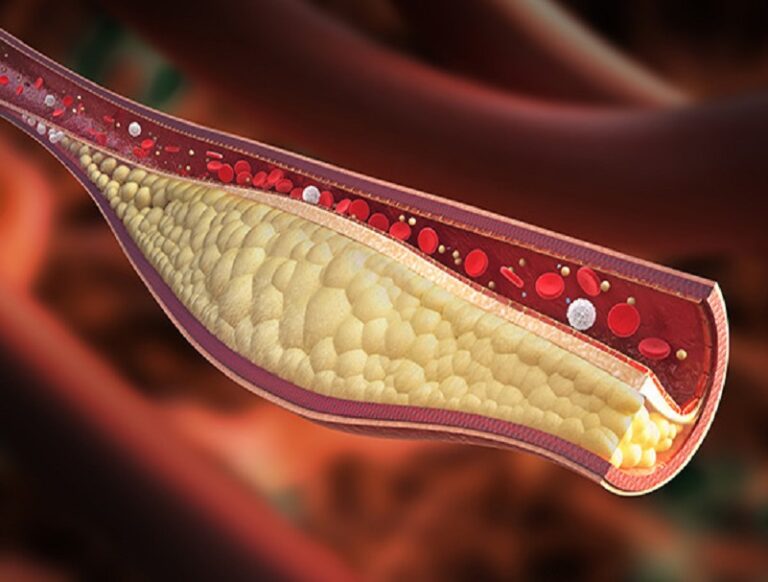 What is Hypercholesterolemia?